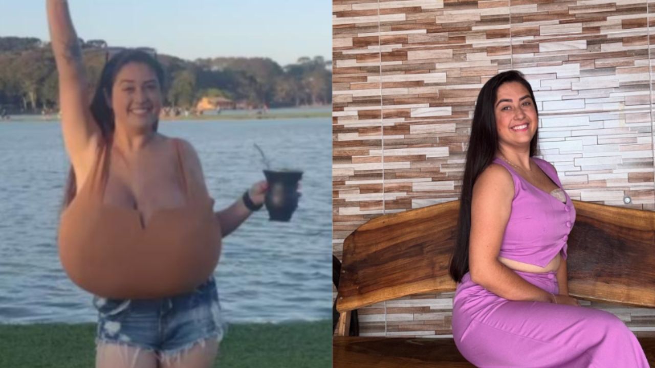 Jovem do Paraná retira 10 kg de mama em cirurgia após diagnóstico de condição rara