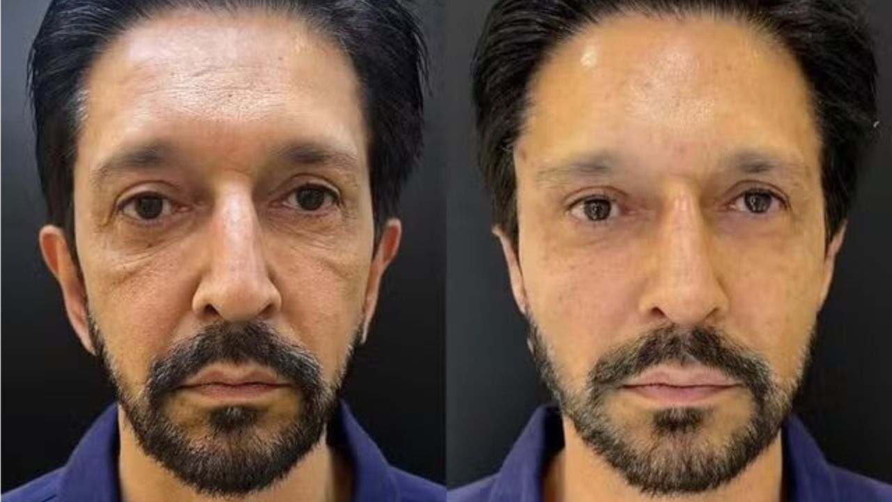 Prefeito de São Paulo, Ricardo Nunes, faz harmonização facial e imagem viraliza nas redes